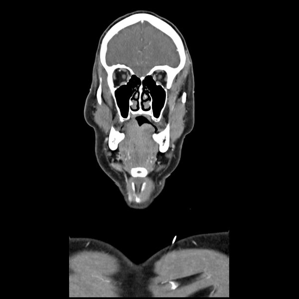 File:Cerebellar infarct due to vertebral artery dissection with posterior fossa decompression (Radiopaedia 82779-97029 D 15).png
