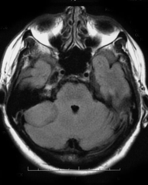 File:Cerebellopontine angle meningioma (Radiopaedia 2597-6293 Axial FLAIR 1).jpg