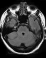 Cerebellopontine angle meningioma (Radiopaedia 2597-6293 Axial FLAIR 1).jpg