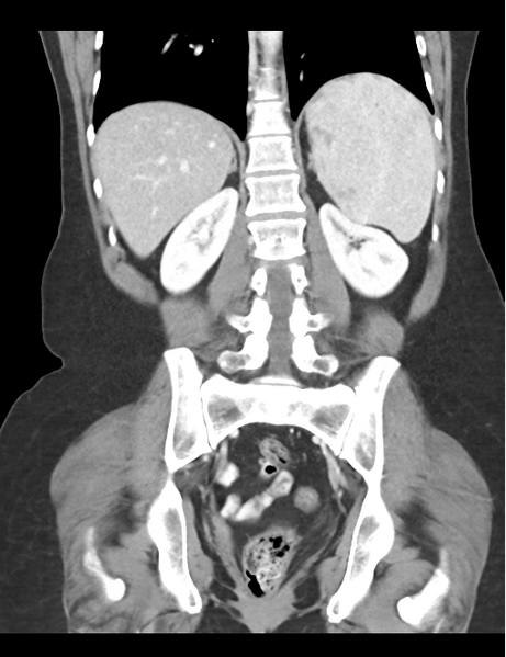 File:Cerebral abscess from pulmonary arteriovenous malformation (Radiopaedia 86275-102292 D 36).png