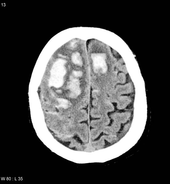File:Cerebral abscesses secondary to contusions (Radiopaedia 5201-22213 Axial non-contrast 6).jpg
