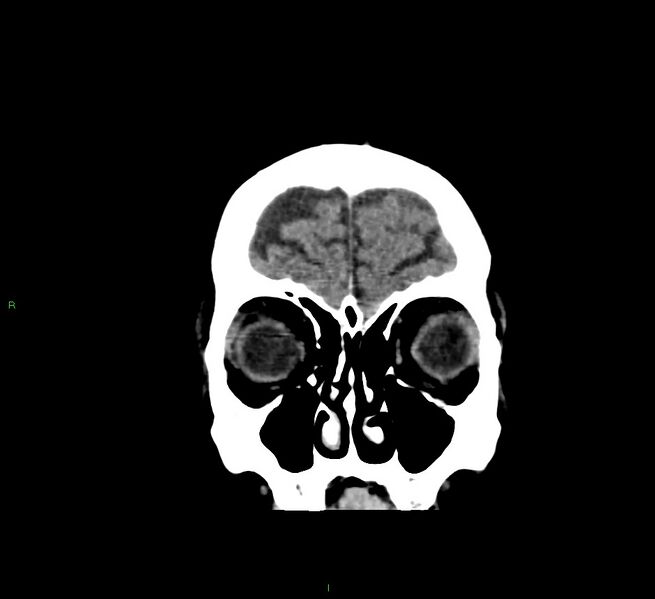 File:Cerebral amyloid angiopathy-associated lobar intracerebral hemorrhage (Radiopaedia 58376-65511 Coronal non-contrast 56).jpg