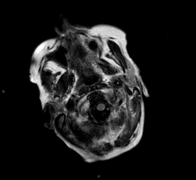File:Cerebral amyloid angiopathy-associated lobar intracerebral hemorrhage (Radiopaedia 58377-65515 Axial FLAIR 25).jpg