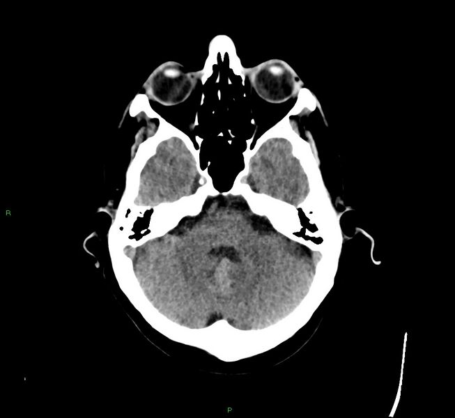 File:Cerebral amyloid angiopathy-associated lobar intracerebral hemorrhage (Radiopaedia 58529-65681 Axial non-contrast 39).jpg