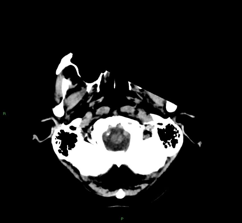 Cerebral amyloid angiopathy-associated lobar intracerebral hemorrhage (Radiopaedia 58530-65688 Axial non-contrast 46).jpg