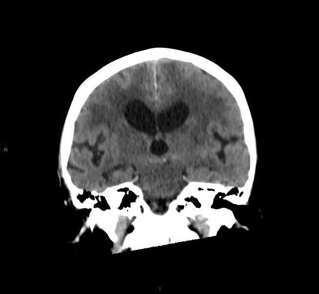 File:Cerebral amyloid angiopathy-associated lobar intracerebral hemorrhage (Radiopaedia 58530-65688 Coronal non-contrast 35).jpg