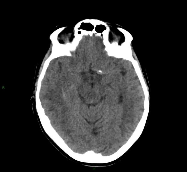 File:Cerebral amyloid angiopathy-associated lobar intracerebral hemorrhage (Radiopaedia 58566-65730 Axial non-contrast 32).jpg