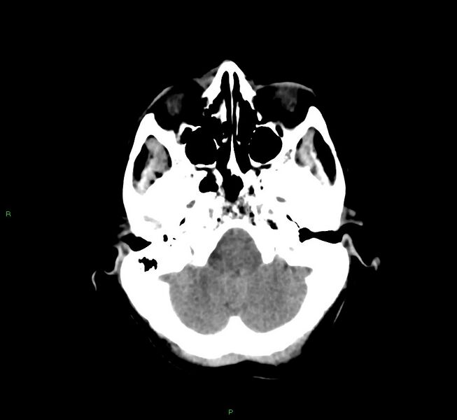 File:Cerebral amyloid angiopathy-associated lobar intracerebral hemorrhage (Radiopaedia 58751-65972 Axial non-contrast 41).jpg