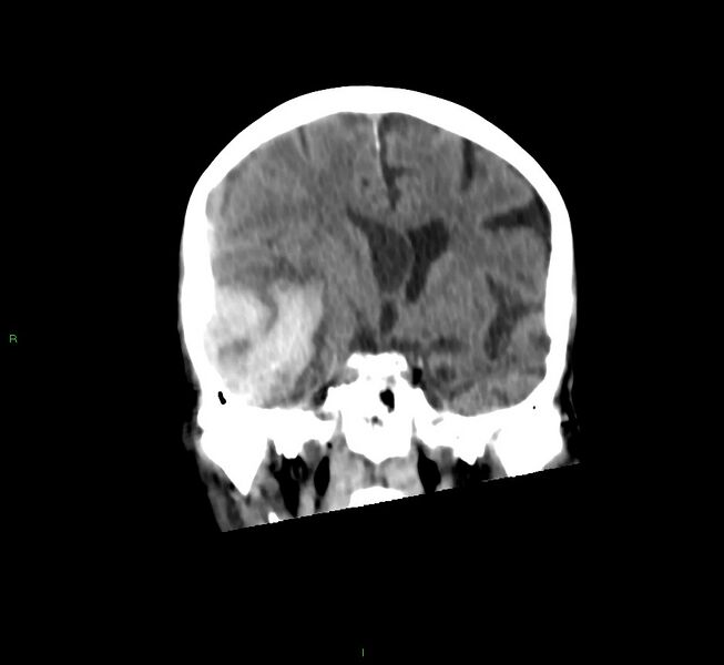 File:Cerebral amyloid angiopathy-associated lobar intracerebral hemorrhage (Radiopaedia 58758-65980 Coronal non-contrast 37).jpg