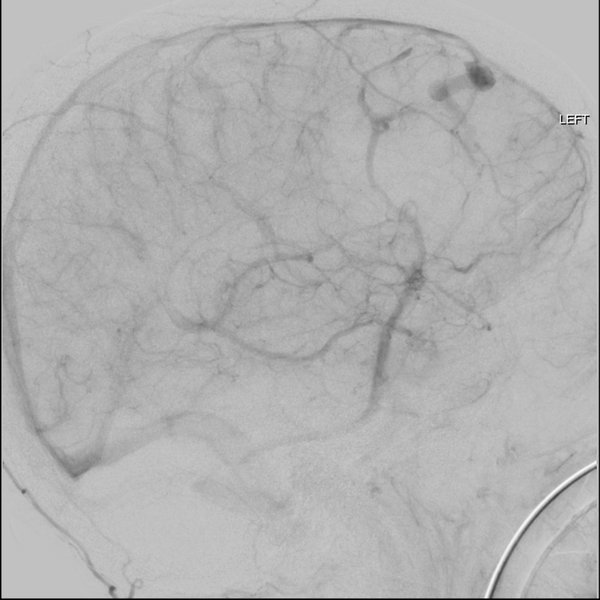 File:Cerebral arteriovenous malformation with lobar hemorrhage (Radiopaedia 44725-48513 LT CCA IC 40).png