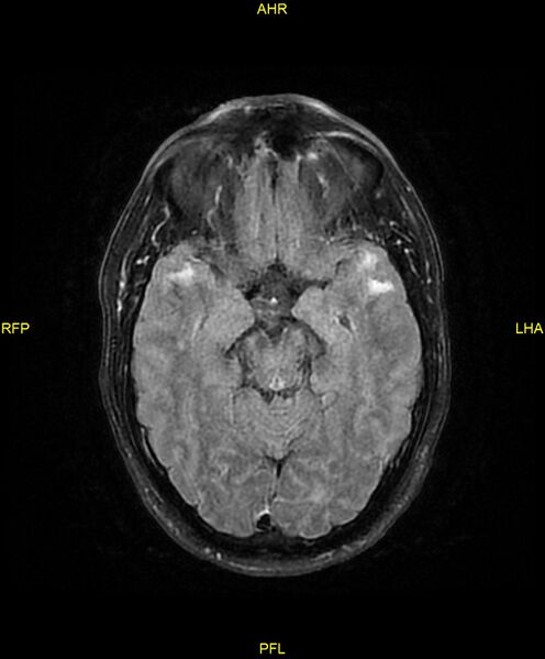 File:Cerebral autosomal dominant arteriopathy with subcortical infarcts and leukoencephalopathy (CADASIL) (Radiopaedia 86108-102054 Axial FLAIR 12).jpg