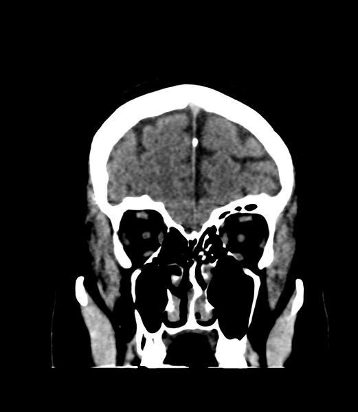 File:Cerebral dural venous sinus thrombosis (Radiopaedia 86514-102575 Coronal non-contrast 6).jpg
