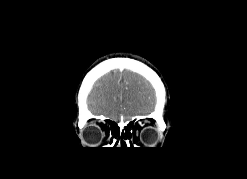 File:Cerebral edema (Radiopaedia 82519-96661 C 53).jpg