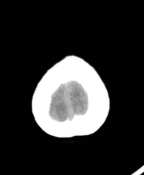 File:Cerebral edema due to severe hyponatremia (Radiopaedia 89826-106937 Axial non-contrast 88).jpg