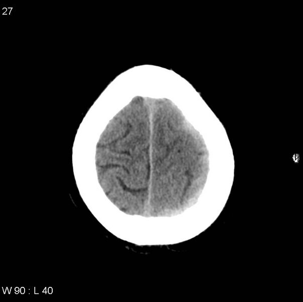 File:Cerebral hemorrhagic contusion with subdural and subarachnoid hemorrhage (Radiopaedia 10680-11146 Axial non-contrast 24).jpg