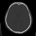 Cerebral hemorrhagic contusions (Radiopaedia 23145-23188 Axial bone window 33).jpg