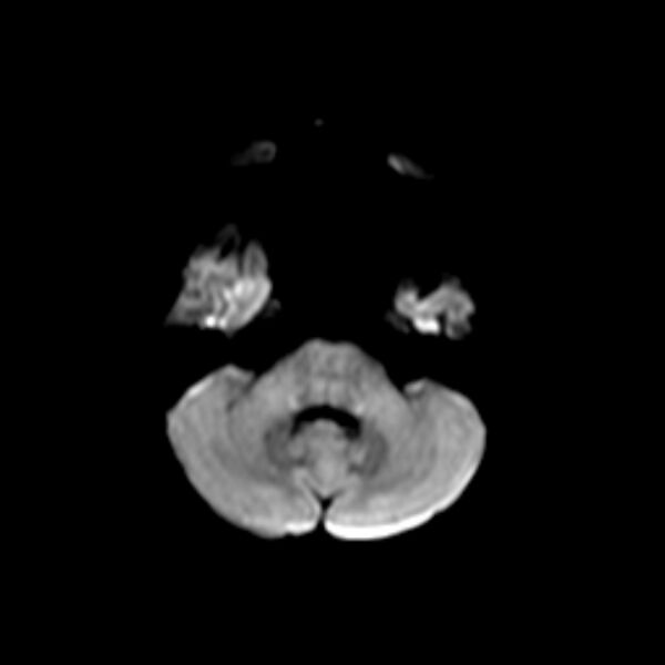 File:Cerebral tuberculoma (Radiopaedia 41152-43932 Axial DWI 3).jpg