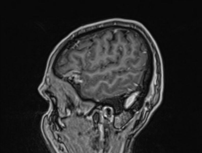 File:Cerebral venous thrombosis (Radiopaedia 71207-81504 Sagittal T1 C+ 56).jpg