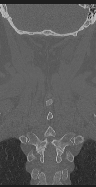File:Cervical canal stenosis - OPLL and osteophytes (Radiopaedia 47329-51910 Coronal bone window 51).png