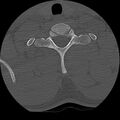 Cervical flexion teardrop fracture with cord hemorrhage (Radiopaedia 32497-33454 Axial bone window 72).jpg