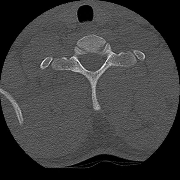 File:Cervical flexion teardrop fracture with cord hemorrhage (Radiopaedia 32497-33454 Axial bone window 72).jpg