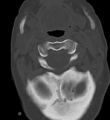 Cervical spine ACDF loosening (Radiopaedia 48998-54070 Axial bone window 16).png