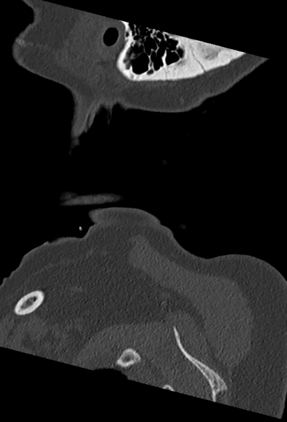 File:Cervical spine ACDF loosening (Radiopaedia 48998-54070 Sagittal bone window 3).png