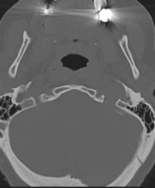 File:Cervical spine ACDF loosening (Radiopaedia 48998-54071 Axial bone window 8).png
