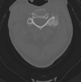 Cervical spondylolysis (Radiopaedia 49616-54811 Axial bone window 26).png