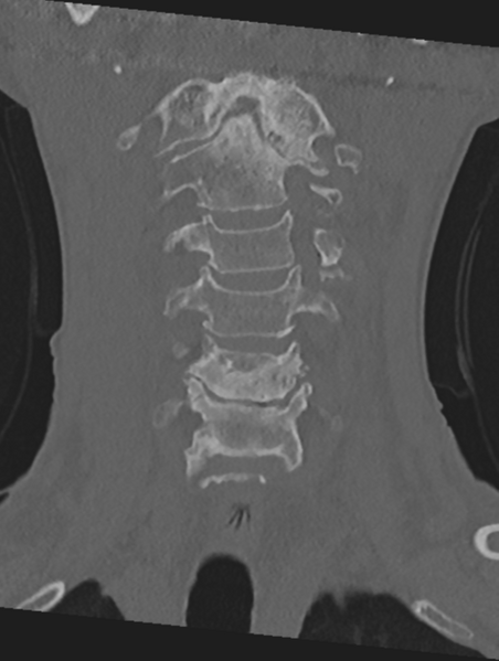 File:Cervical spondylolysis (Radiopaedia 49616-54811 Coronal bone window 14).png