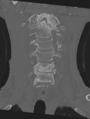 Cervical spondylolysis (Radiopaedia 49616-54811 Coronal bone window 14).png