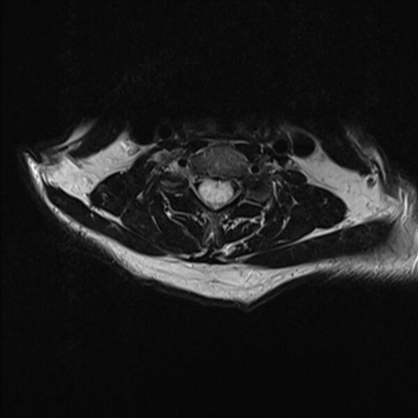 File:Cervical tumor-like myelopathy due to Type V dAVF (Radiopaedia 82461-96604 Axial T2 21).jpg