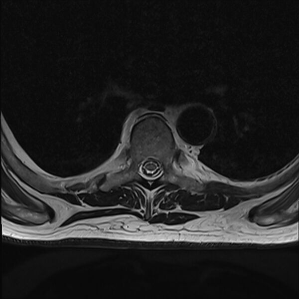 File:Cervical tumor-like myelopathy due to Type V dAVF (Radiopaedia 82461-96604 D 24).jpg