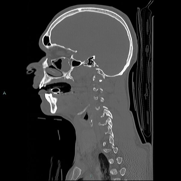 File:Cervical vertebral burst fracture (Radiopaedia 37420-39258 Sagittal bone window 26).jpg