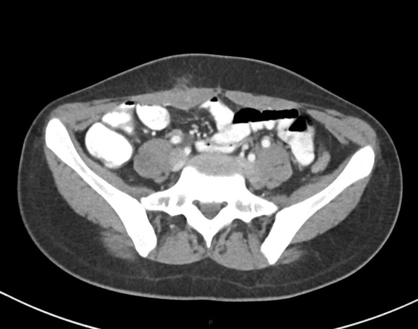 Cesarean scar endometriosis (Radiopaedia 82925-97262 A 59).jpg