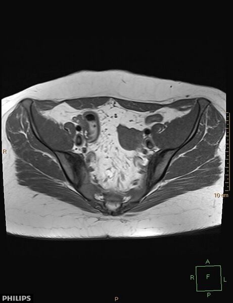 File:Cesarian scar endometriosis (Radiopaedia 68495-78066 Axial T1 7).jpg