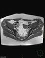 Cesarian scar endometriosis (Radiopaedia 68495-78066 Axial T1 7).jpg