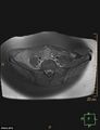 Cesarian scar endometriosis (Radiopaedia 68495-78066 Axial T1 C+ fat sat 1).jpg