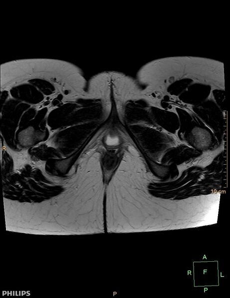 File:Cesarian scar endometriosis (Radiopaedia 68495-78066 Axial T2 27).jpg