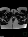 Cesarian scar endometriosis (Radiopaedia 68495-78066 Axial T2 27).jpg