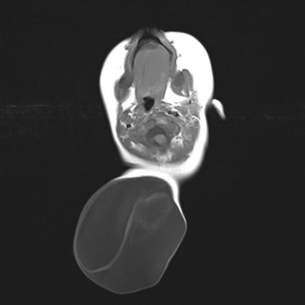 File:Chiari III malformation with occipital encephalocele (Radiopaedia 79446-92559 Axial T1 8).jpg