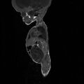 Chiari II malformation with spinal meningomyelocele (Radiopaedia 23550-23652 Sagittal T1 1).jpg