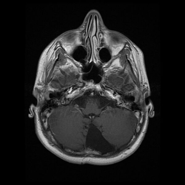 File:Chiasmatic-hypothalamic juvenile pilocytic astrocytoma (Radiopaedia 78533-91236 Axial T1 C+ 8).jpg