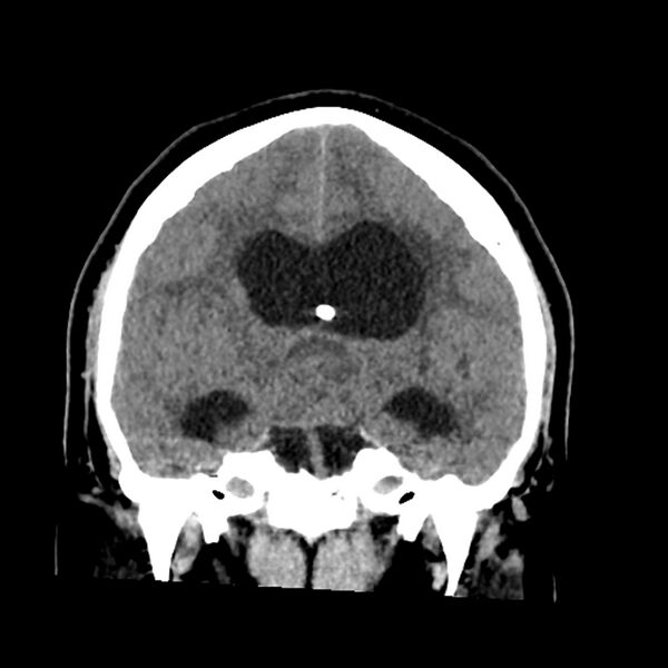 File:Chiasmatic-hypothalamic juvenile pilocytic astrocytoma (Radiopaedia 78533-91237 Coronal non-contrast 35).jpg
