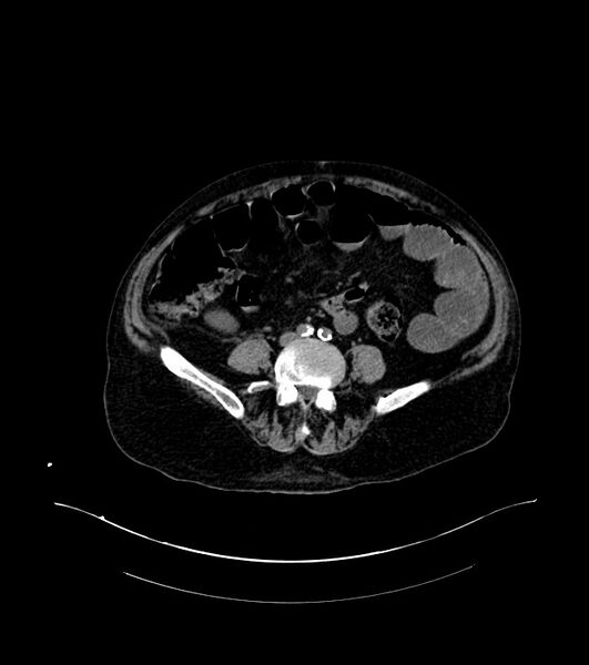 File:Cholangiocarcinoma with cerebral metastases (Radiopaedia 83519-98629 Axial non-contrast 77).jpg