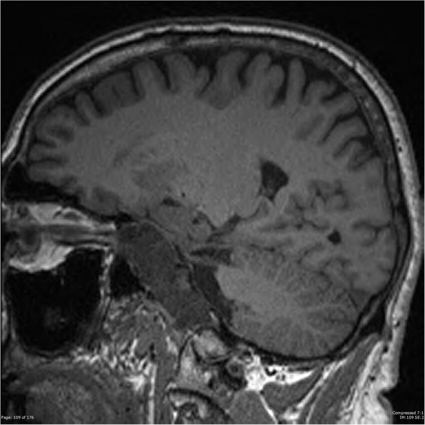 Chondrosarcoma of skull base- grade II (Radiopaedia 40948-43654 Sagittal T1 32).jpg