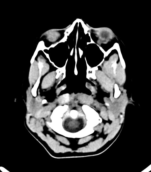 File:Choroid plexus carcinoma (Radiopaedia 91013-108552 Axial non-contrast 6).jpg