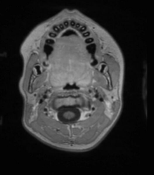 File:Choroid plexus carcinoma (Radiopaedia 91013-108553 Axial T1 C+ 49).jpg