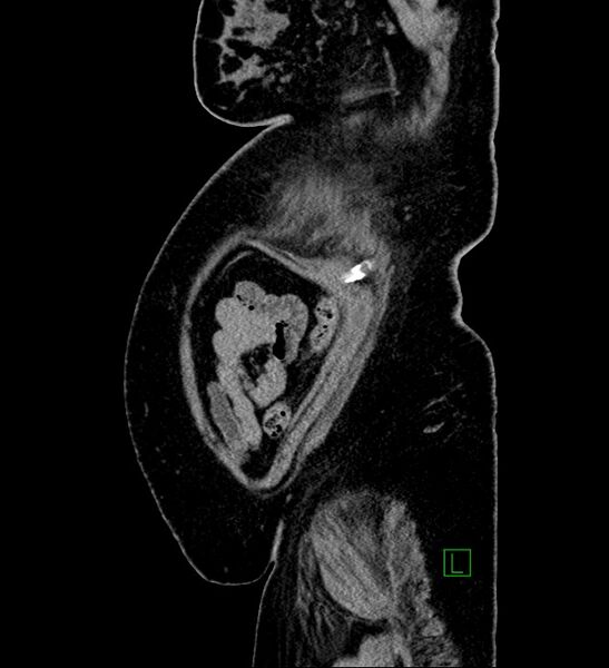 File:Chromophobe renal cell carcinoma (Radiopaedia 84239-99519 G 13).jpg