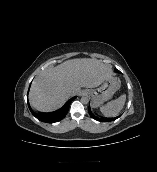 File:Chromophobe renal cell carcinoma (Radiopaedia 84337-99644 Axial non-contrast 14).jpg